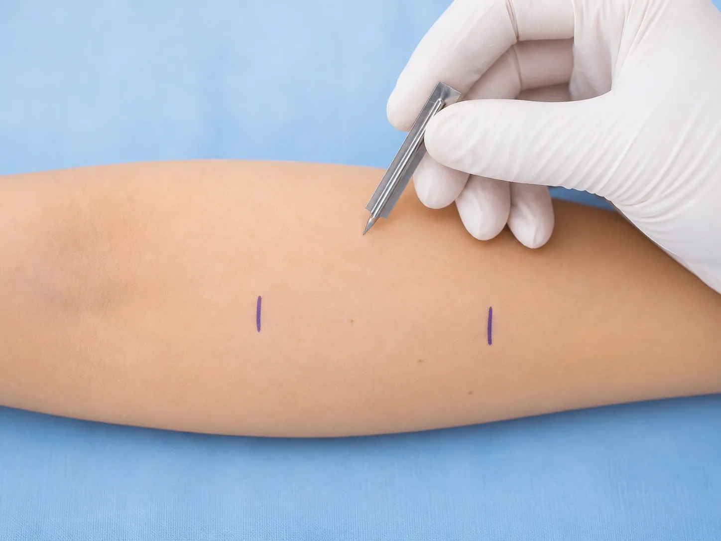 การทดสอบภูมิแพ้ทางผิวหนัง Skin Prick Test โดยการสะกิดผิวหนังที่แขน