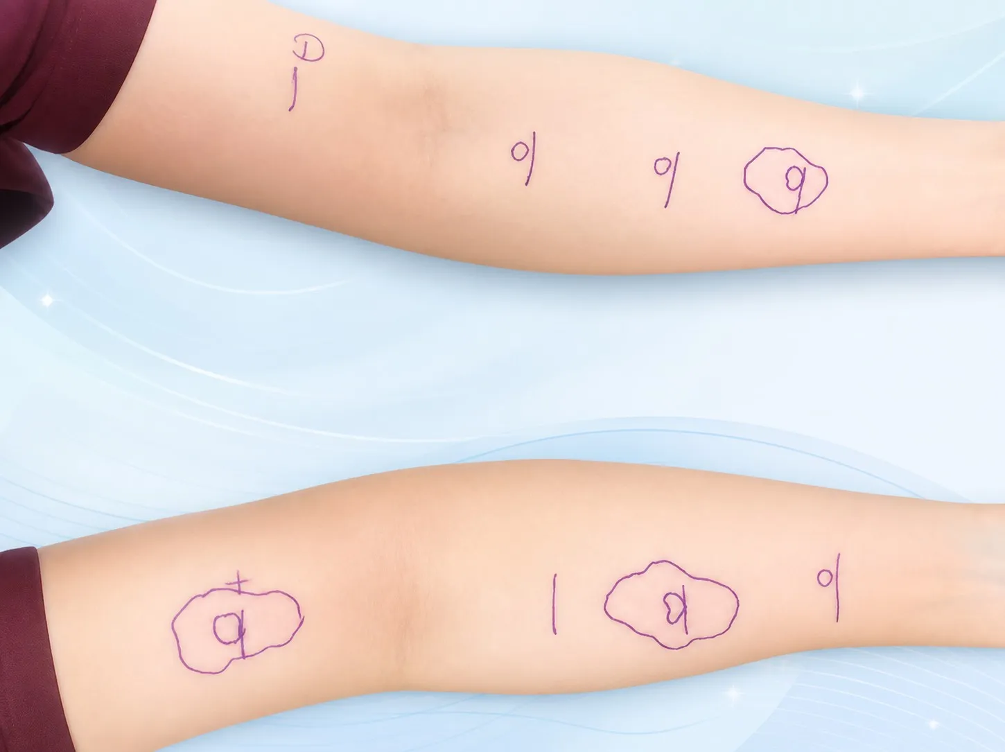 ผลการทดสอบ Skin Prick Test บนแขน แสดงตุ่มนูนแดงบริเวณที่แพ้